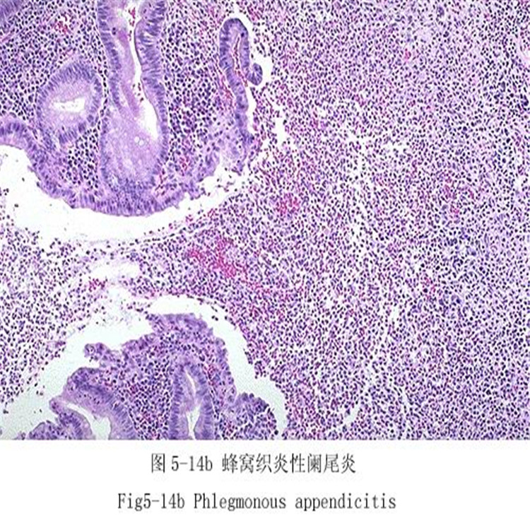 蜂窩織炎性闌尾炎