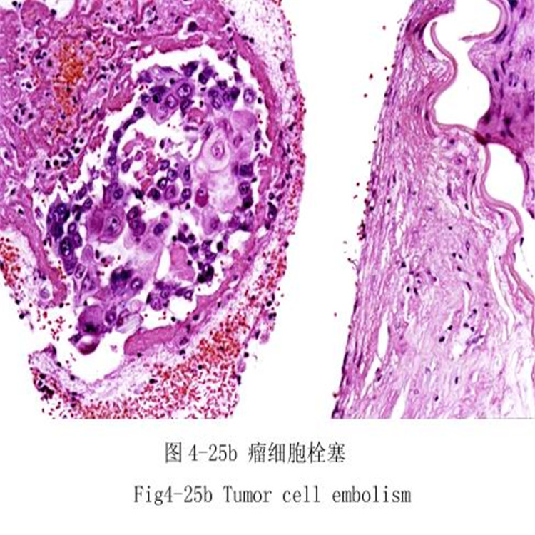 瘤細(xì)胞栓塞