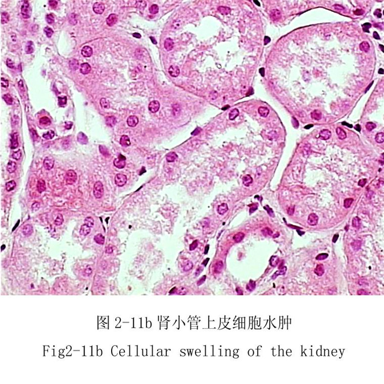 腎小管上皮細(xì)胞水腫