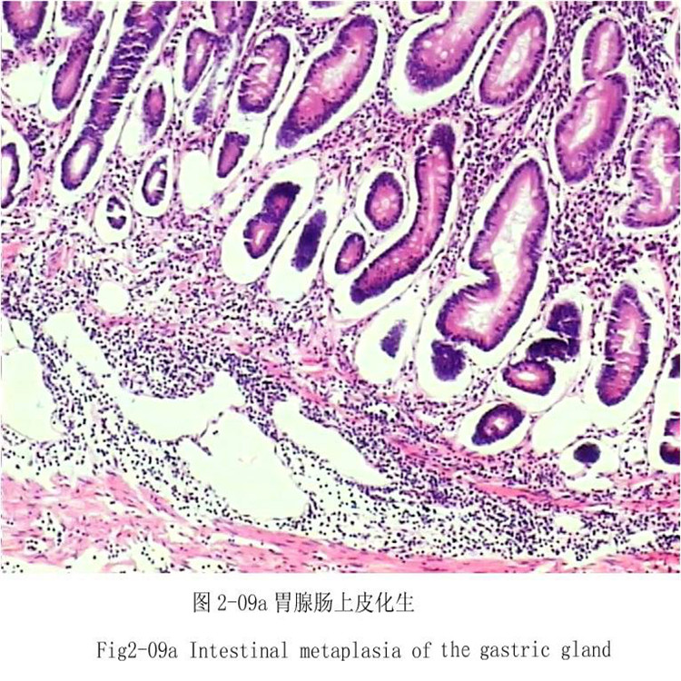 胃腺腸上皮化生